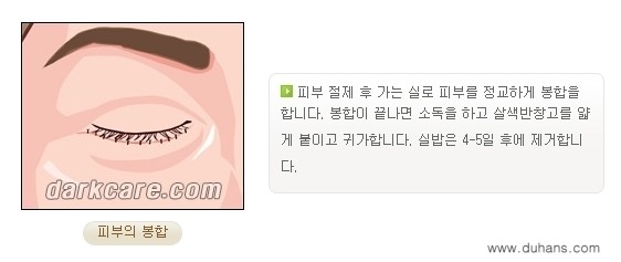​[두한성형외과 NO.1 다크써클 교정] - [하안검 성형술 + 눈밑지방 재배치] 관련 이미지 9
