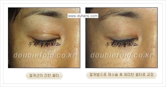[두한성형외과 경쟁력 쌍꺼풀 재수술, 극한 재수술] - [망가진 눈 복원수술 - 흉터선이 진한 경우 교정 안내] 관련 이미지 5