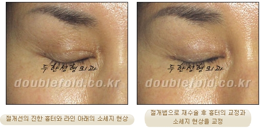 [Duhan Plastic Surgery Eye Surgery] - [Double Eyelid Scar, Double Eyelid Scar Tissue, Revision Surgery for Pigeon Eyes and Ptosis Correction] image 14