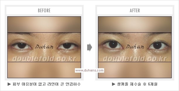 ​[두한성형외과 경쟁력 쌍꺼풀 재수술] - [아름다운 쌍꺼풀 선의 기준과 쌍꺼풀 재수술시 검사와 테스트 안내] 관련 이미지 17
