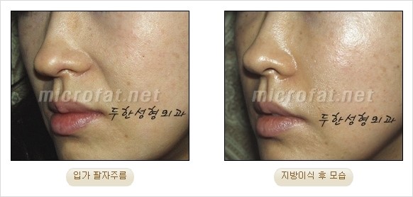 [두한성형외과 경쟁력 안티에이징 동안성형] - [주름이 깊은 푹~ 꺼진 입가 팔자주름 안녕!] 관련 이미지 20