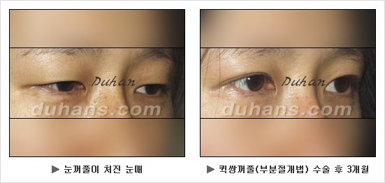 [두한성형외과 경쟁력 눈성형] - [눈성형 방법에 대한 흔한 질문과 답변 안내] 관련 이미지 2