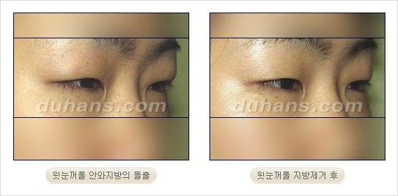[두한성형외과 경쟁력 지방제거] - [눈꺼풀 지방제거 흔한 질문과 답변 모음] 관련 이미지 3