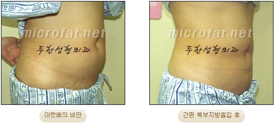 두한성형외과 지방흡입 - 부위별 안전 지방흡입 관련 이미지 19