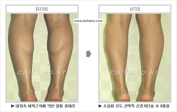 [두한성형외과 경쟁력 멀티종아리성형] - [종아리성형 전후 주의해야 할 내용 안내] 관련 이미지 16