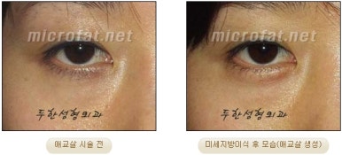 두한성형외과 눈밑성형 - 애교필러 후 눈밑재수술 관련 이미지 52