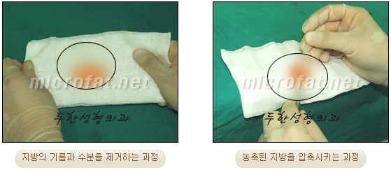 Duhan Plastic Surgery Wrinkle Improvement - Glabellar Horizontal Wrinkles, Glabellar Straight Wrinkles, Glabellar Wrinkle Surgery image 5
