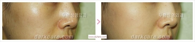 [두한성형외과 경쟁력 멀티성형] - [다크써클 + 인디언밴드 콤비 프로그램 안내] 관련 이미지 10