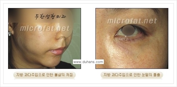 ⁠[두한성형외과 경쟁력 미세지방이식] - [미세지방이식의 부작용 문제 교정 안내] 관련 이미지 4