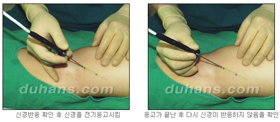[두한성형외과 종아리축소술] - [초음파 유도 선택적 신경차단술 안내] 관련 이미지 14