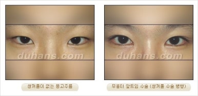 쌍커풀수술 두한성형외과 - 나에게 맞는 눈성형은? 관련 이미지 60