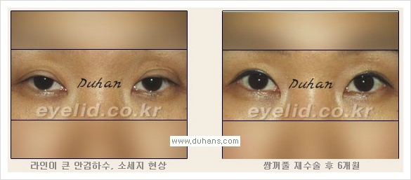 [두한성형외과 경쟁력 눈성형] - [안검하수와 몽고주름에 대한 자주하는 질문과 답변] 관련 이미지 12