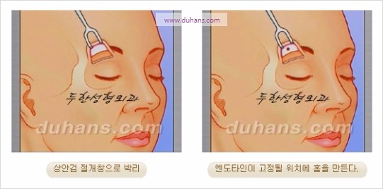 [두한성형외과 주름성형] - [주름교정술 - 강력한 리프팅 파워 엔도타인 리프팅 ] 관련 이미지 30