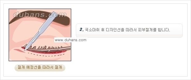 [두한성형외과 경쟁력 안검성형] - [젊은 눈매 하안검 성형술 안내] 관련 이미지 4