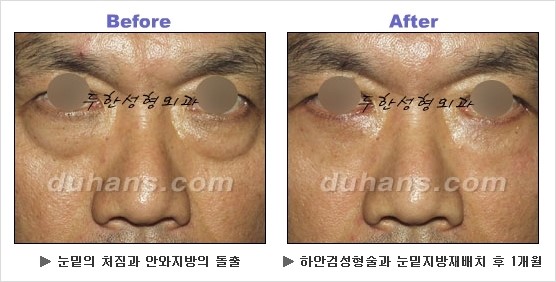 [두한성형외과 경쟁력 동안성형 리더] - ​[미간주름, 이마주름, 안검성형, 이마거상술, 눈썹거상술] 관련 이미지 85
