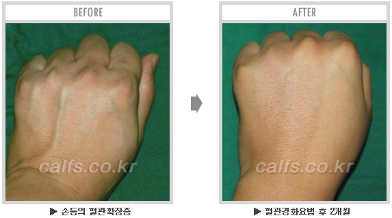 [종아리성형 두한성형외과] - [종아리수술에 대한 자주하는 질문과 답변 모음] 관련 이미지 34