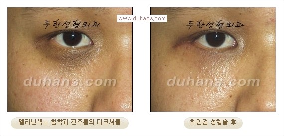 [두한성형외과 경쟁력 다크써클 교정] - [젊어 보이면서 개선된 인상을 주는 하안검 성형술] 관련 이미지 18