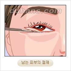 [두한성형외과 경쟁력 동안성형 리더] - ​[미간주름, 이마주름, 안검성형, 이마거상술, 눈썹거상술] 관련 이미지 63
