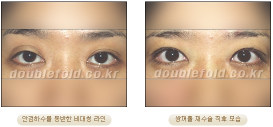 [두한성형외과 쌍수] - [재수술 실패의 원인, 재수술의 성공 요건] 관련 이미지 45
