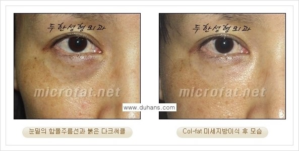 [두한성형외과 경쟁력 눈밑성형] - [눈밑 다크써클과 눈밑 함몰주름의 최적화 교정방법 안내] 관련 이미지 31