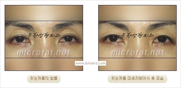 [두한성형외과 경쟁력 쌍꺼풀 재수술, 극한 눈재수술] - [어색한 쌍꺼풀 라인을 교정하는 윗눈꺼풀 미세지방이식] 관련 이미지 16
