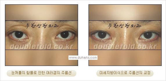 ​⁠⁠[두한성형외과 경쟁력 쌍꺼풀 재수술, 극한 눈재수술] - [지방이식으로 눈매와 쌍꺼풀 라인을 교정] 관련 이미지 20