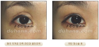 [Special Double Eyelid Revision Surgery at Duhan Plastic Surgery] - [Restorative Surgery for Damaged Double Eyelid Eye Shape] image 11