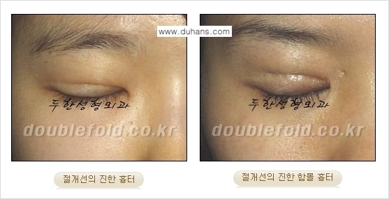 [두한성형외과 경쟁력 쌍꺼풀 재수술] - [흉터선이 진한 경우] 관련 이미지 2