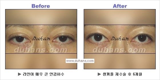 [두한성형외과 경쟁력 쌍꺼풀 재수술, 극한 눈재수술] - [과한 아웃폴드 쌍꺼풀 라인 교정 방법] 관련 이미지 2