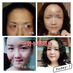이마성형 두한성형외과 - 이마주름, 이마지방이식 관련 이미지 16
