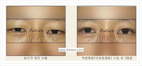 [두한성형외과 경쟁력 쌍꺼풀 재수술, 극한 재수술] - [쌍꺼풀 수술 관련 질문과 답변] 관련 이미지 7