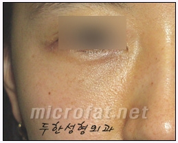 [두한성형외과 지방이식] - [다크서클, 눈밑주름] 관련 이미지 47