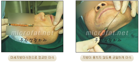 [Duhan Plastic Surgery Double Eyelid Revision Surgery] - [Correcting the Double Eyelid Line in Sunken Eyelids] image 56