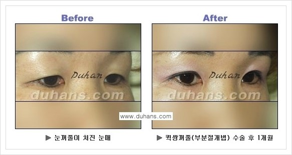 [두한성형외과 경쟁력 눈성형] - [퀵쌍꺼풀 수술 전후 정보 안내 ②] 관련 이미지 14