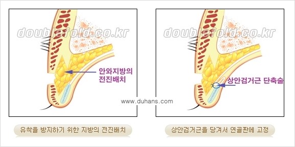 [두한성형외과 경쟁력 눈성형] - [안검하수 수술 방법] 관련 이미지 3