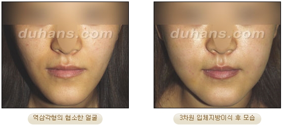 [두한성형외과 얼굴자가지방이식] - [볼살, 이마, 측두부] 관련 이미지 13
