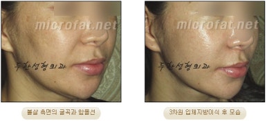 [두한성형외과 얼굴지방이식] - [볼지방이식] 관련 이미지 25