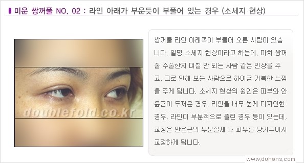 [두한성형외과 경쟁력 쌍꺼풀 재수술, 극한 눈재수술] - [Dr. 컬럼 - 재수술의 목표] 관련 이미지 5
