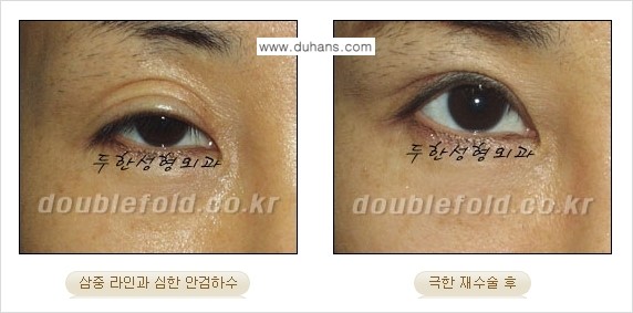 [두한성형외과 NO.1 경쟁력 눈성형] - [일반 쌍꺼풀 재수술과 극한 눈(쌍꺼풀) 재수술과의 차이점] 관련 이미지 6