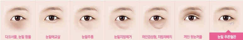 [두한성형외과 다크서클] - [다크서클 전후사진 검증] 관련 이미지 187
