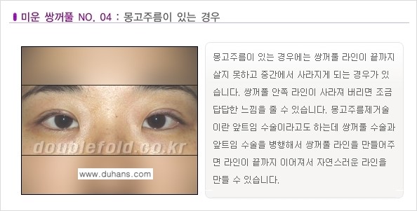 [두한성형외과 경쟁력 눈성형] - [미운 쌍꺼풀이란?] 관련 이미지 5
