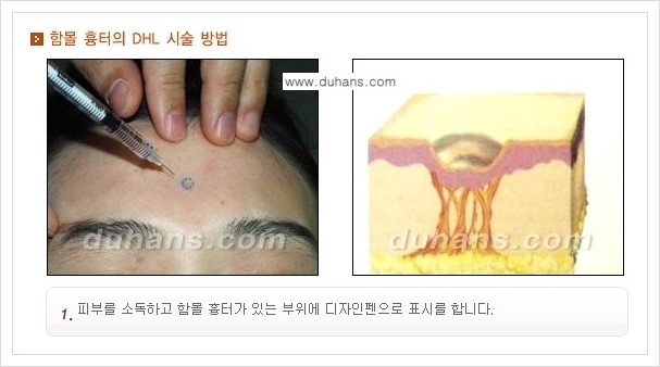 [두한성형외과 경쟁력 함몰 흉터 교정] - [동시에 3가지 시술로 효과적인 함몰 흉터 교정 안내] 관련 이미지 4