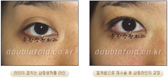 [두한성형외과 눈재수술] - [재수술 방법들] 관련 이미지 23