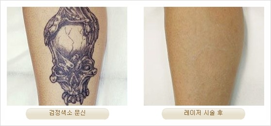 [두한성형외과 경쟁력 안전성형] - [최첨단 장비를 이용한 흉터, 점, 주근깨, 잡티, 문신제거 레이저 시술] 관련 이미지 29