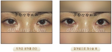 Best Place for Revision Eyelid Surgery, Duhan Plastic Surgery - Lowering Double Eyelid Line image 39