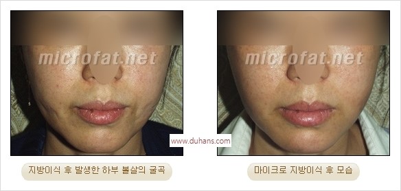 [두한성형외과 경쟁력 미세지방이식] - [지방이식 부작용 교정 모습 안내] 관련 이미지 20