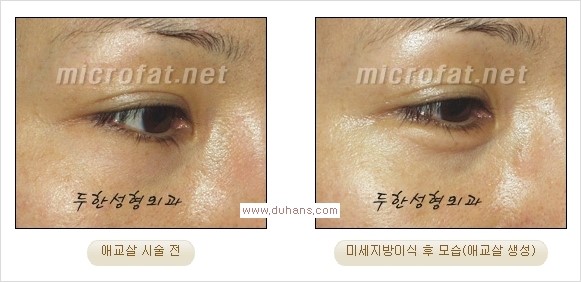 [두한성형외과 경쟁력 눈밑성형] - [타 병원 필러 애교살 시술 부작용을 미세지방이식으로 교정] 관련 이미지 27