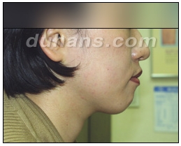 [Duhan Plastic Surgery Clinic Aesthetic Procedures] - [Square Jaw Botox] image 15