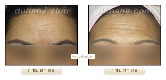 [Dr. 컬럼] - [주름교정을 위한 미세지방이식] 관련 이미지 3