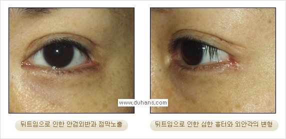 [두한성형외과 경쟁력 쌍꺼풀 재수술, 극한 눈재수술] - [뒤트임 수술의 부작용 안내] 관련 이미지 6